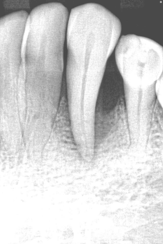 lanap before